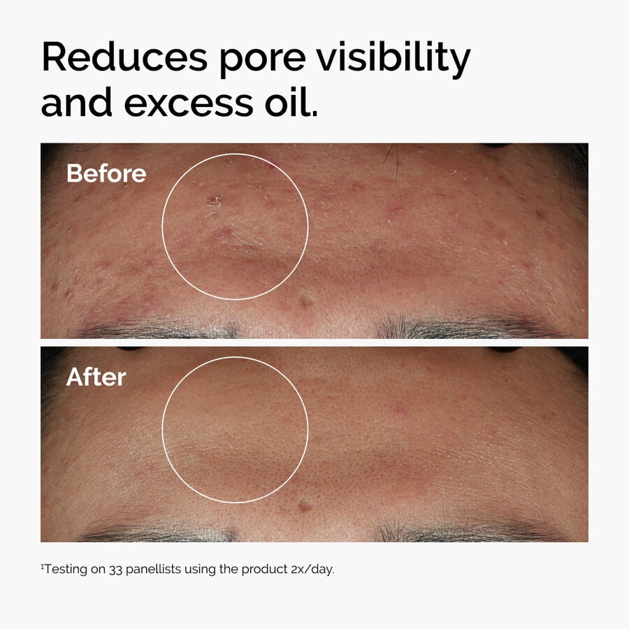 niacinamide-10-zinc-1-u8 ord-niacinamide-zinc-blemish-serum-before-after-pores.jpg