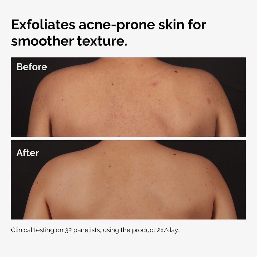 the-body-care-collection-l4 ord-salicylic-acid-body-serum-before-after-graphic-NA.jpg
